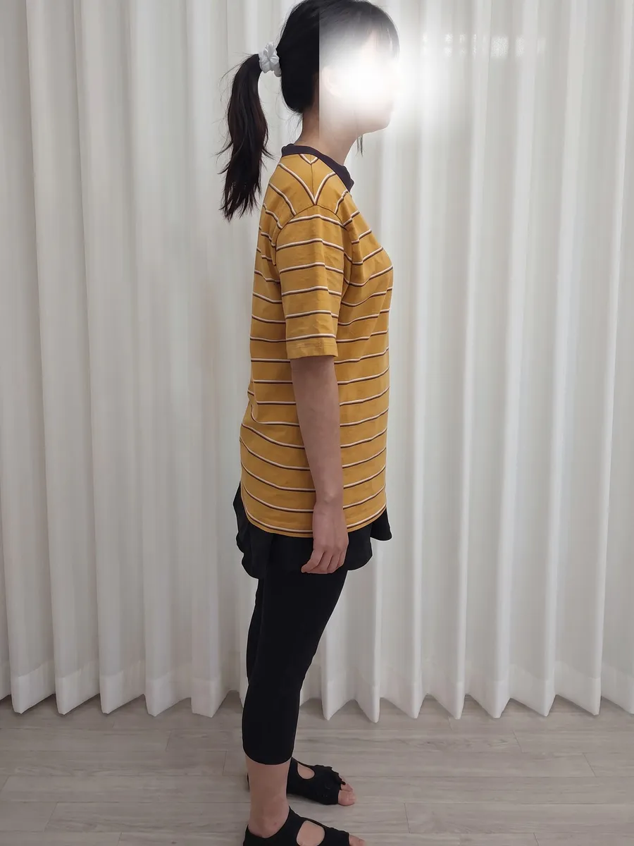 소뇌 손상 회원 · 5개월 40회 35회차 옆모습 1 자세 비교 사진