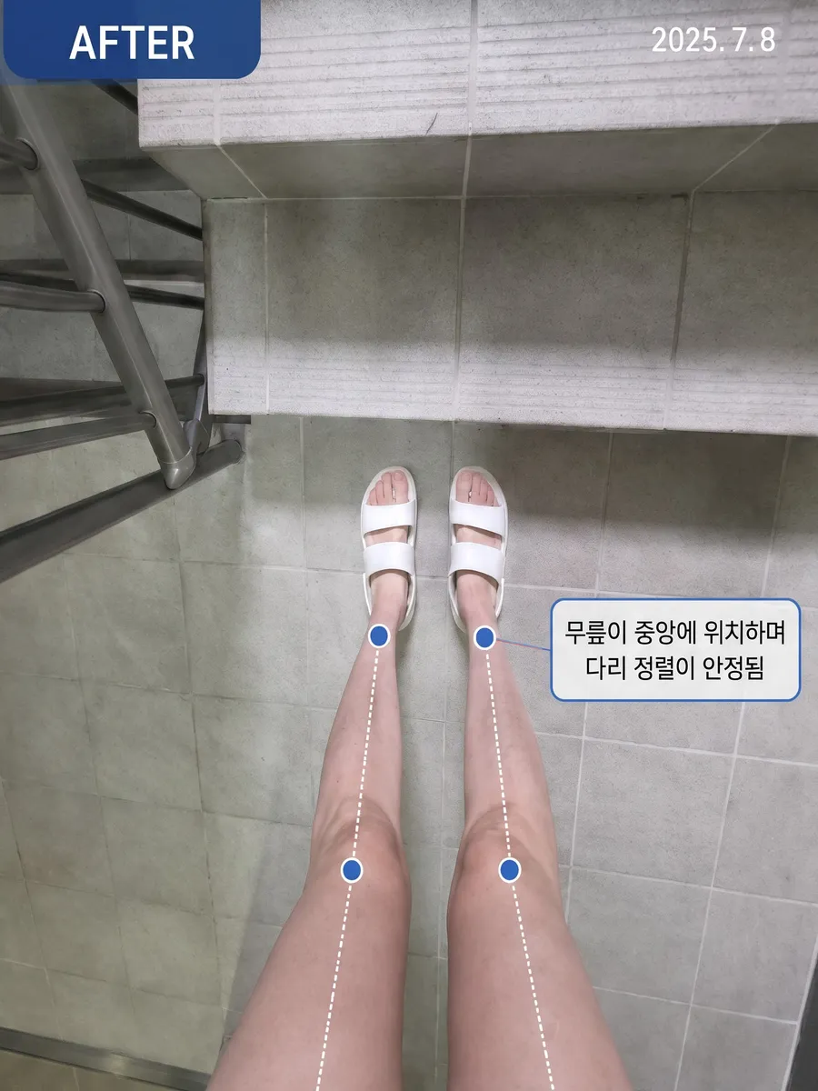 무릎 정렬 · 3주 (2025.6.19 → 7.8) 2025.7.8 자세 비교 사진