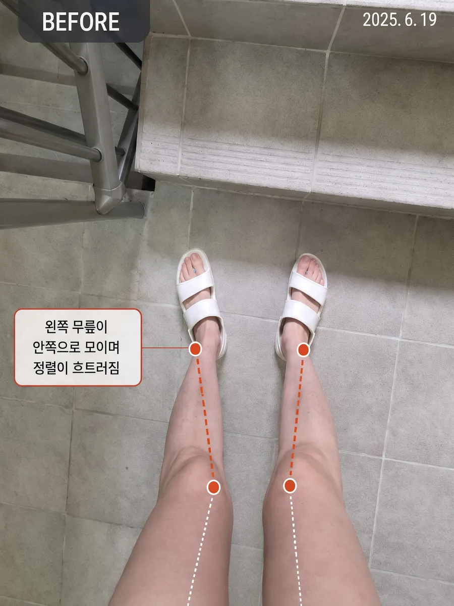 무릎 정렬 · 3주 (2025.6.19 → 7.8) 2025.6.19 자세 비교 사진